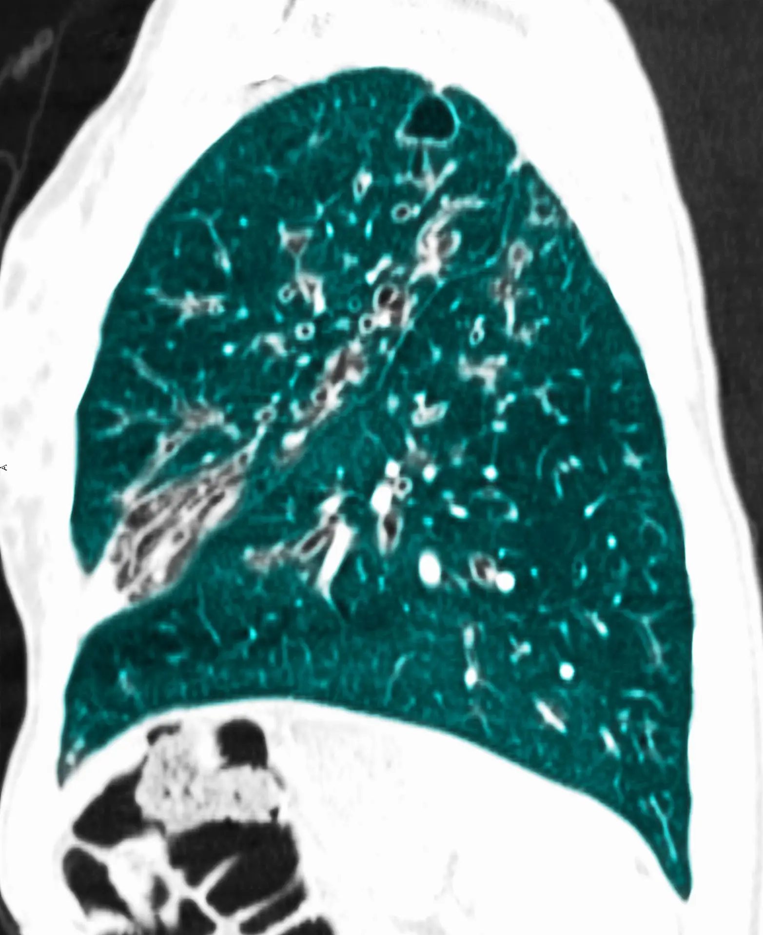 Pneumologista diz que número de doentes com fibrose quística com fármacos inovadores já é significativo