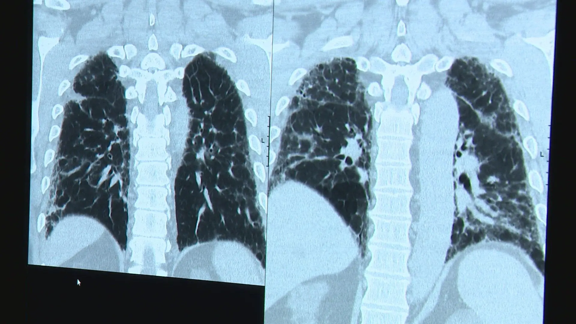 "Quando respirar é asfixiante": campanha alerta para importância de diagnóstico precoce na fibrose pulmonar