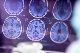 EUA aprovam o primeiro medicamento para a doença de Alzheimer