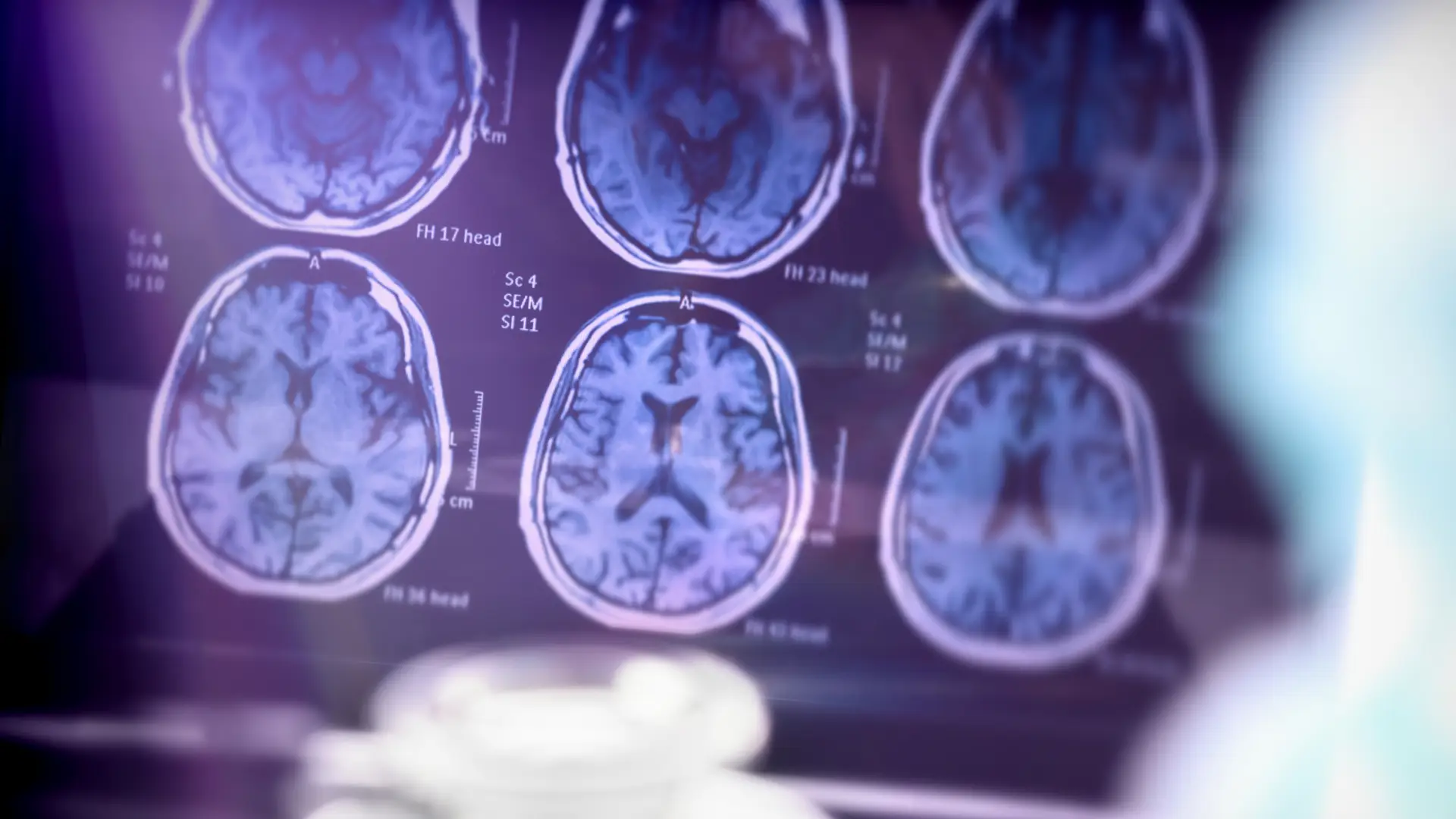 Doença de Alzheimer atinge precocemente diferentes regiões cerebrais, segundo cientistas