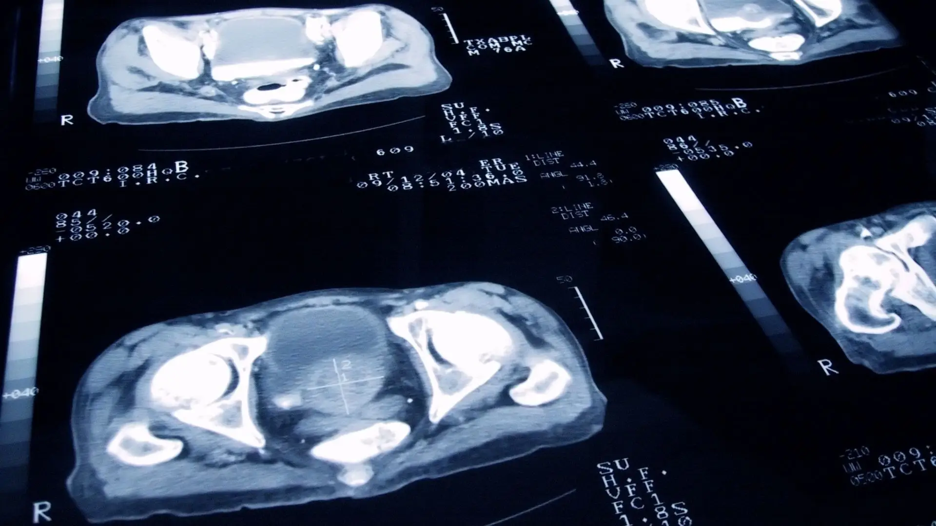 Investigadores do Porto em projeto inovador de combate ao cancro da próstata