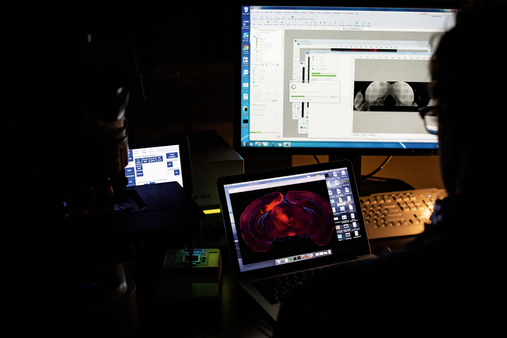 Perto de 450 mil rastreios aos cancros da mama, do útero e do colo e reto ficaram por realizar no primeiro ano de pandemia