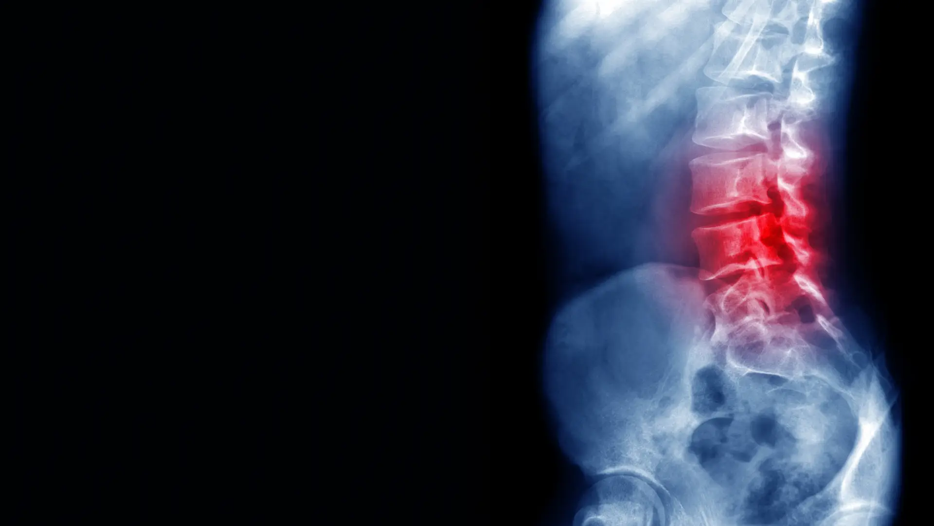 Três paraplégicos voltam a andar devido a implantes eletrónicos