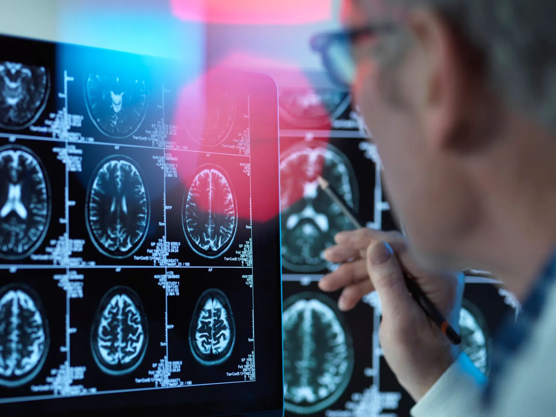 Dormir a sesta com frequência ou por muito tempo pode ser sinal de Alzheimer ou demência, revela estudo