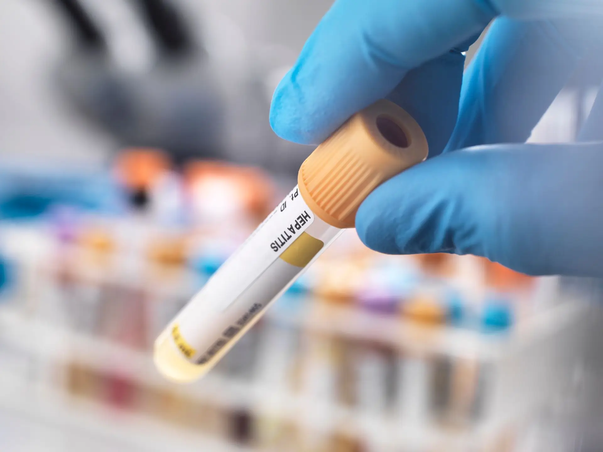 Espanha registou 13 casos de hepatite aguda atípica em crianças