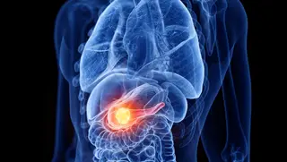 Cancro do pâncreas: terapia utrassónica abre caminho a novos tratamentos