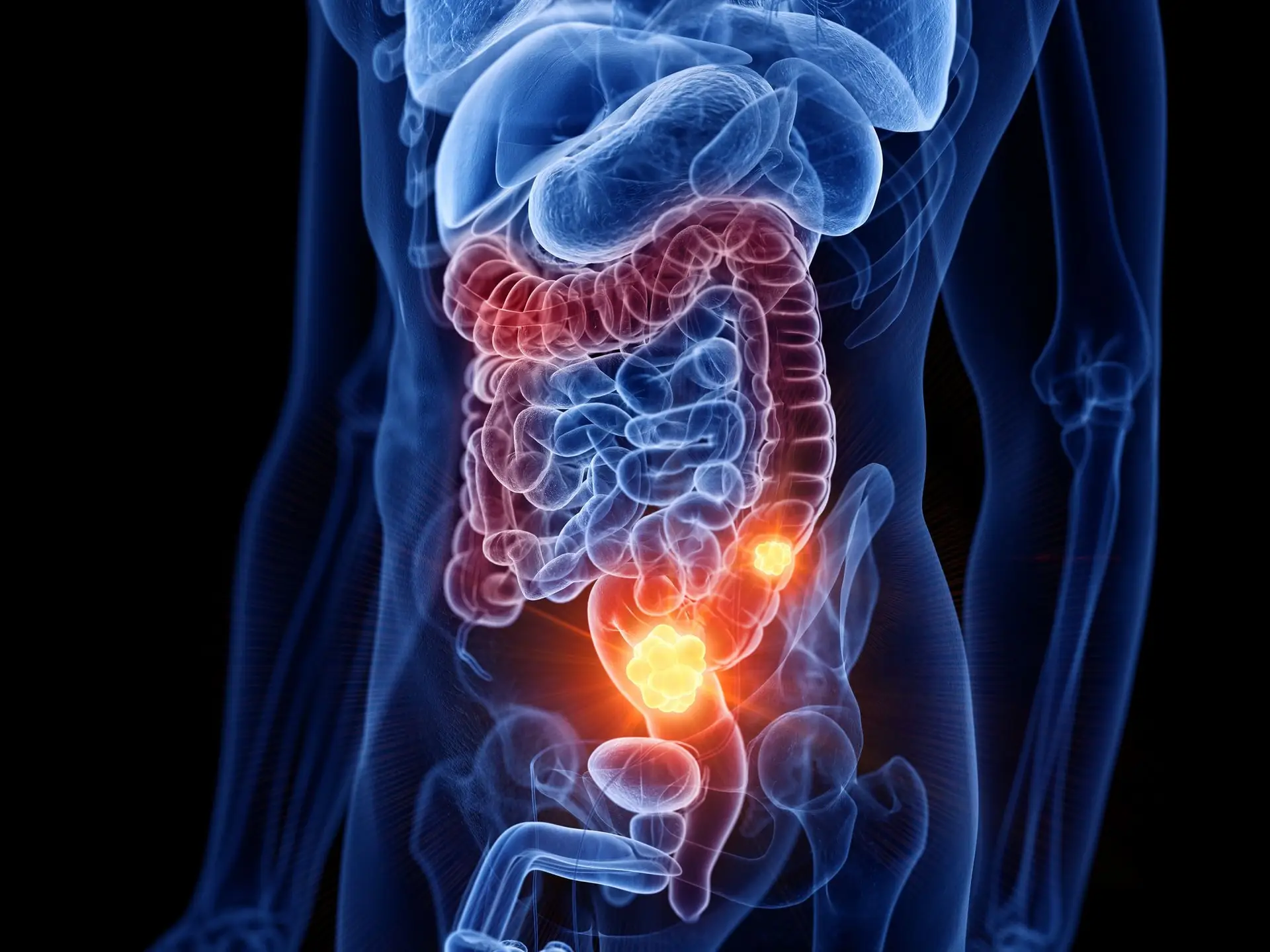 Medicamento aumenta esperança de vida a doentes com cancro do cólon em estado avançado