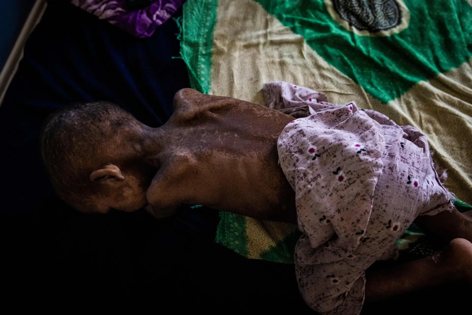 Fome: mais de 350 mil crianças com menos de cinco anos em risco de morte na Somália