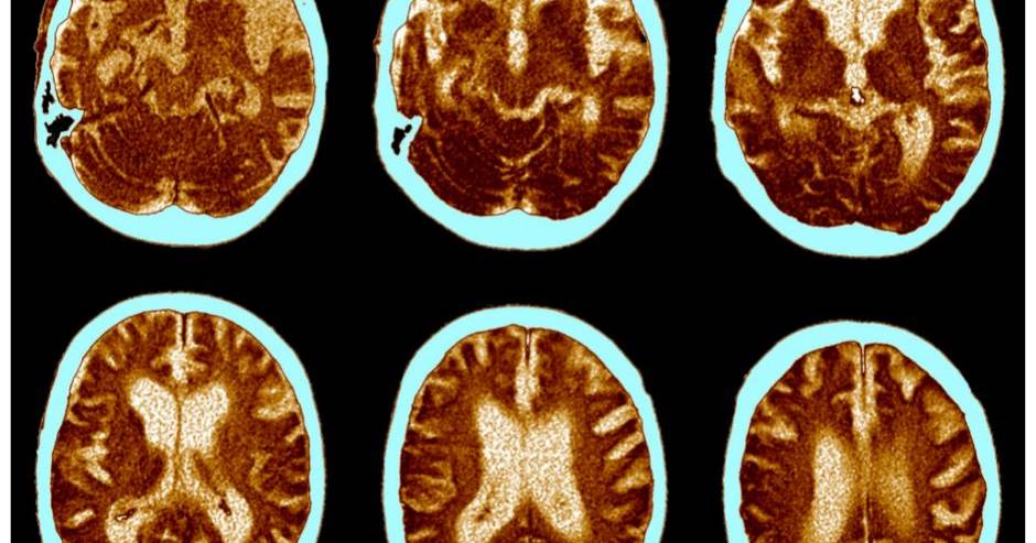 Die Entdeckung ebnet den Weg für die Entwicklung neuer Therapien für die Alzheimer-Krankheit