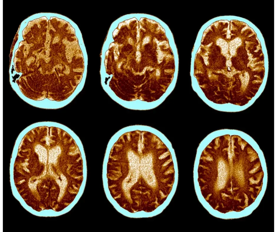 Descoberta abre caminho ao desenvolvimento de novas terapias para a doença de Alzheimer