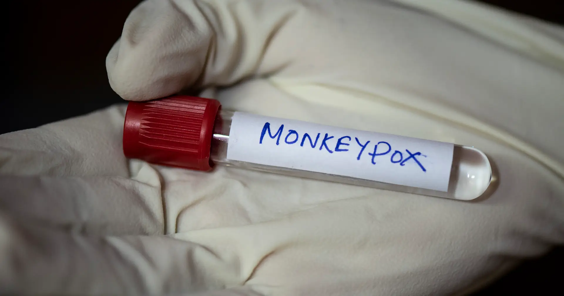 España registra la segunda muerte por viruela del simio