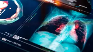 Identificada mutação genética associada a linfomas e cancro do pulmão