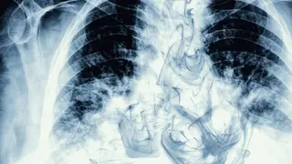 Dia Mundial do Cancro do Pulmão: Hospital São João recorre a técnica pouco invasiva