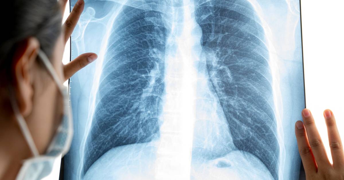 Investigadores descobrem tratamento promissor para fibrose pulmonar idiopática