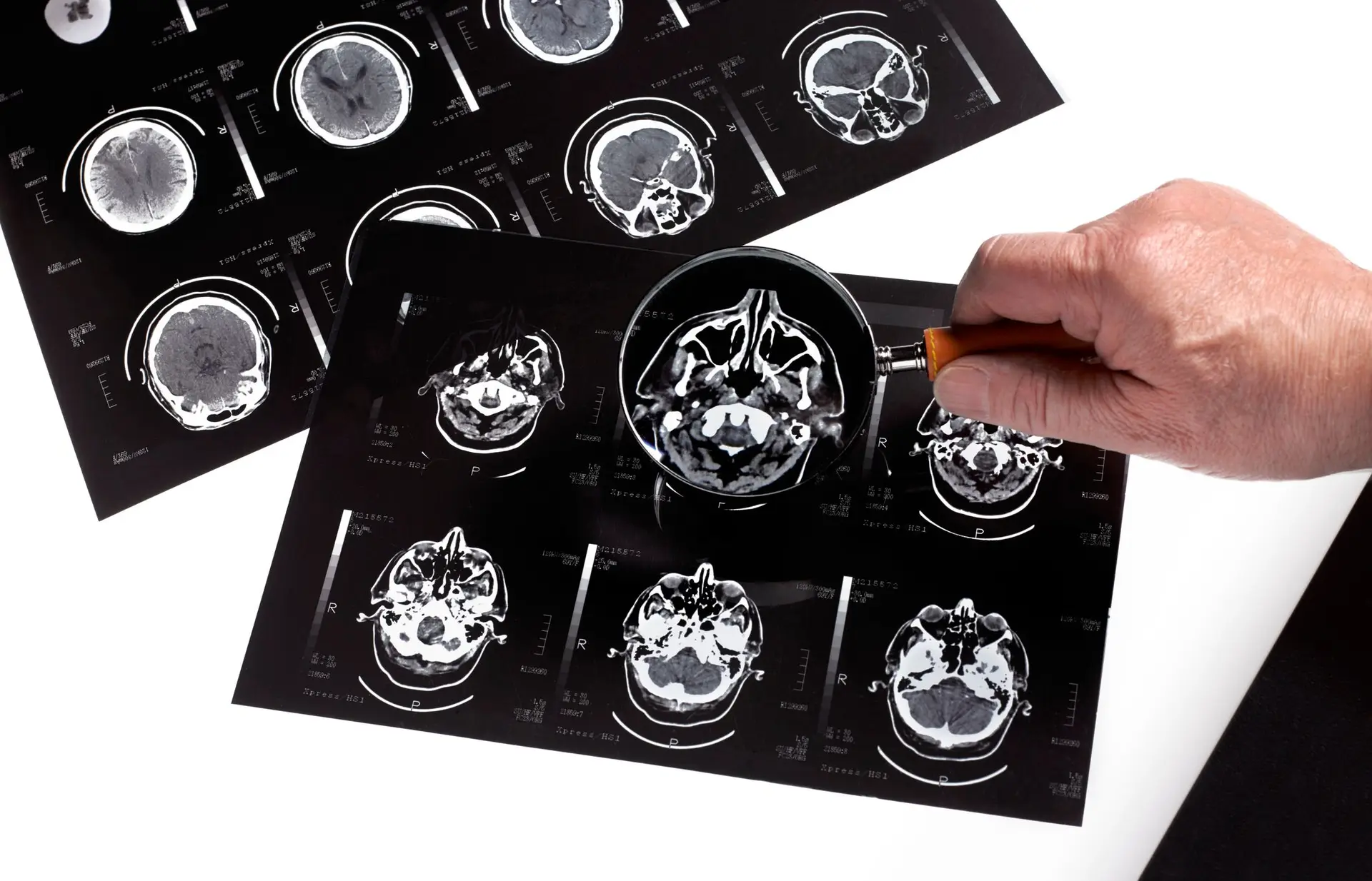 EUA autorizam novo tratamento para doença de Alzheimer