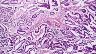 Descoberto gene que acelera o crescimento do cancro do cólon