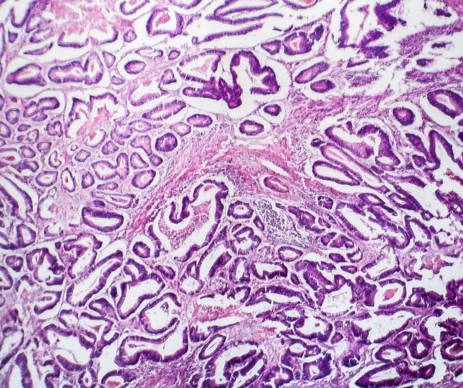 Imagem microscópia de tecido de tumor do cólon.