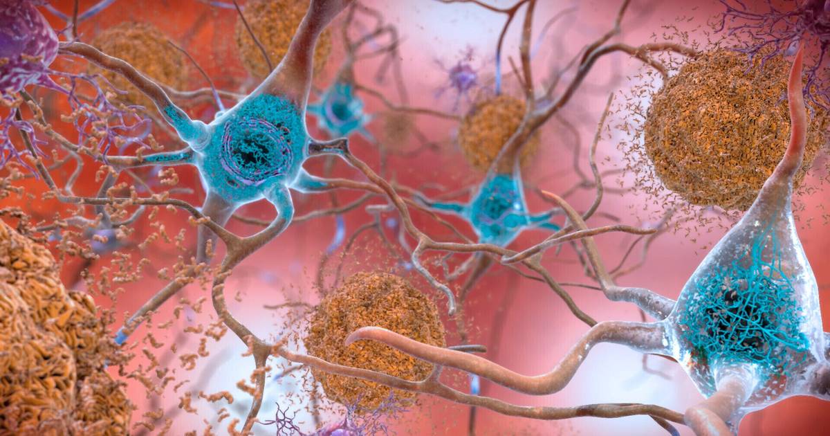 Nova estratégia para “limpar” o cérebro mostra potencial contra doença de Alzheimer