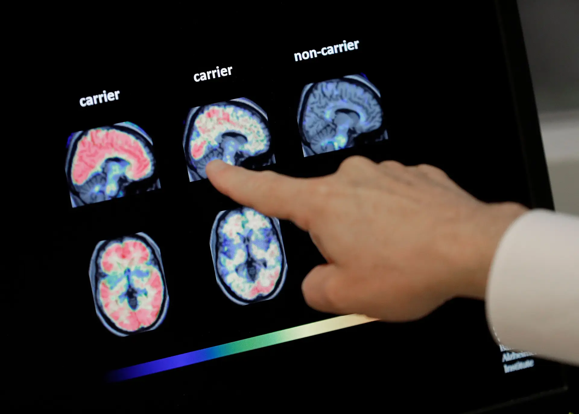 Cérebros resistentes ao Alzheimer? Estudo revela conclusões surpreendentes