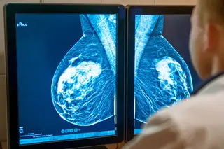 Quase 18 mil pedem fármaco inovador para cancro da mama, Infarmed analisa situação