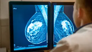 Medicamento contra cancro da mama triplo-negativo já tem financiamento aprovado