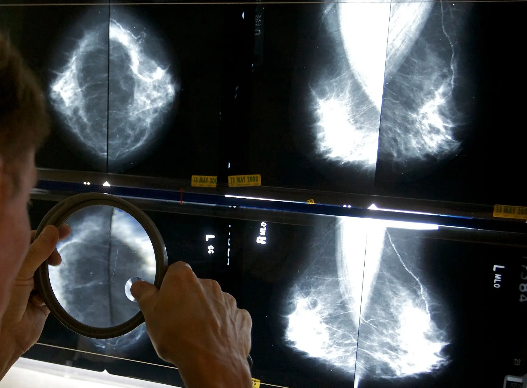 Inteligência Artificial pode ajudar "com segurança" no rastreio do cancro de mama