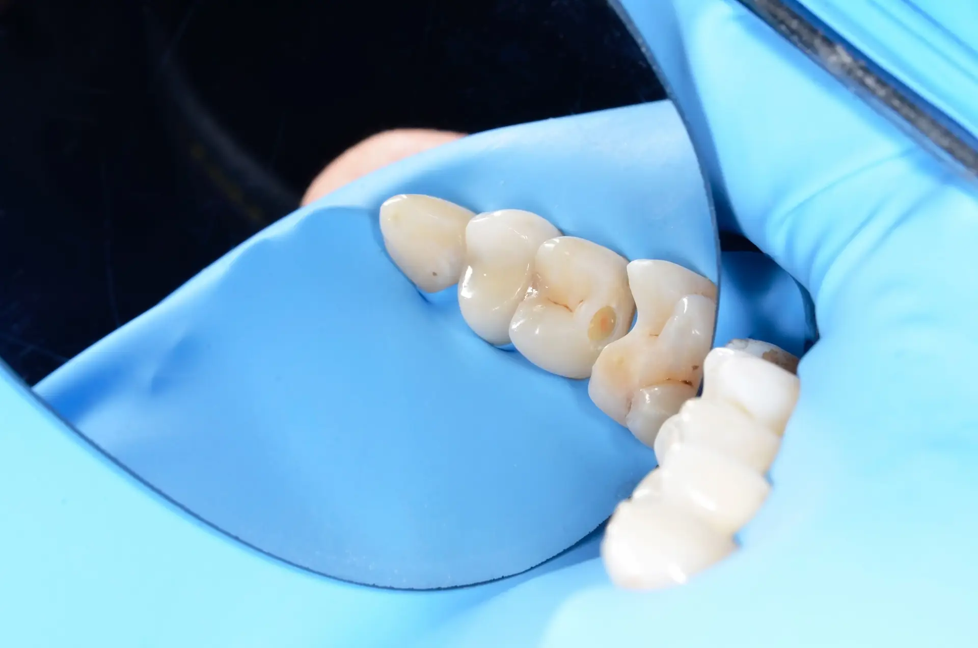 Rede acusada de roubar cadáveres na China para usar ossos em enxertos dentários