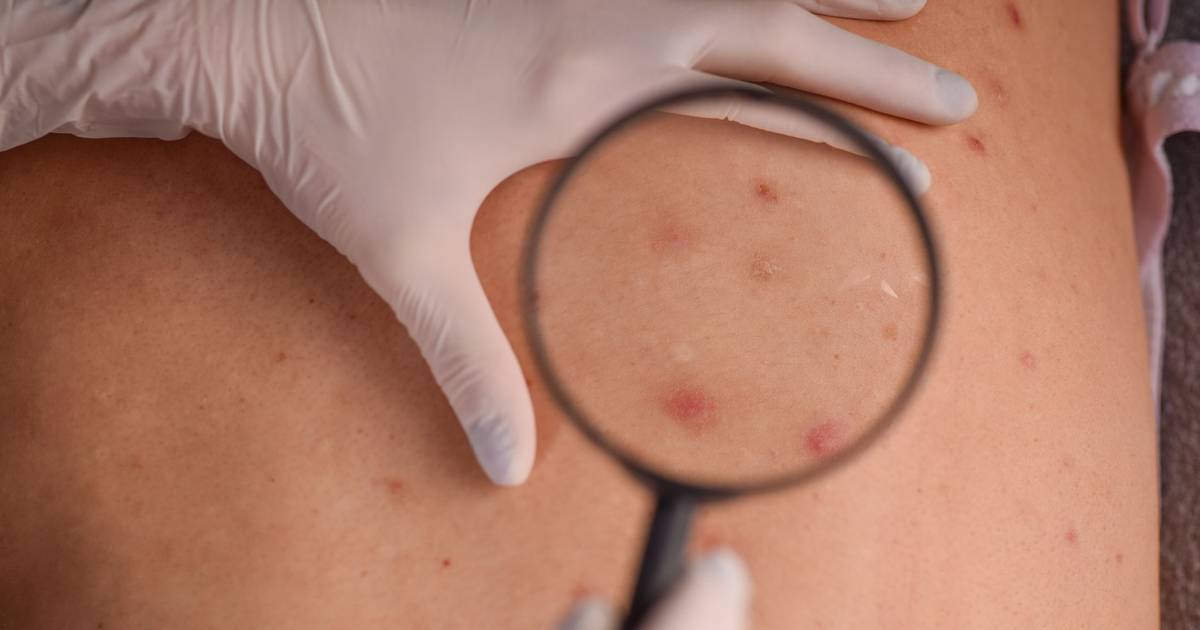 Investigação em Leiria desenvolve ferramenta que ajuda no diagnóstico de lesões cancerígenas na pele