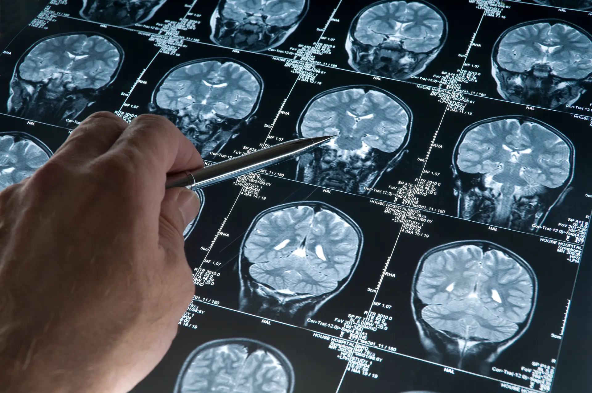 Investigadores tentaram perceber se a exposição à radiação dos telemóveis aumenta a probabilidade de cancro do cérebro