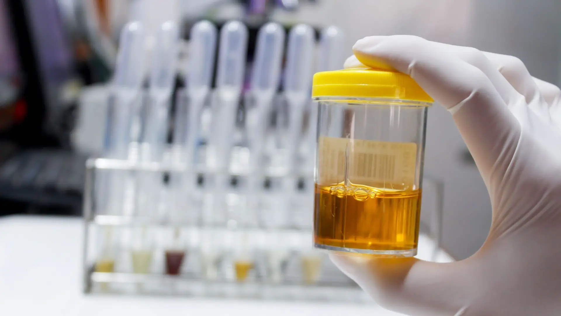 Teste à urina pode revolucionar deteção precoce do cancro do pulmão