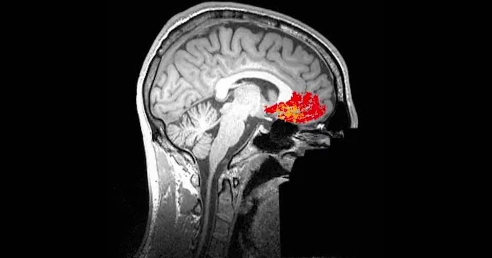 MELD Graph: como a inteligência artificial pode ajudar pessoas com epilepsia