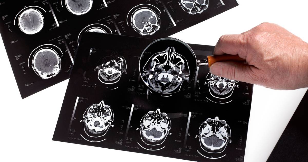 Novos medicamentos para doença de Alzheimer têm benefícios "demasiado reduzidos", conclui estudo independente