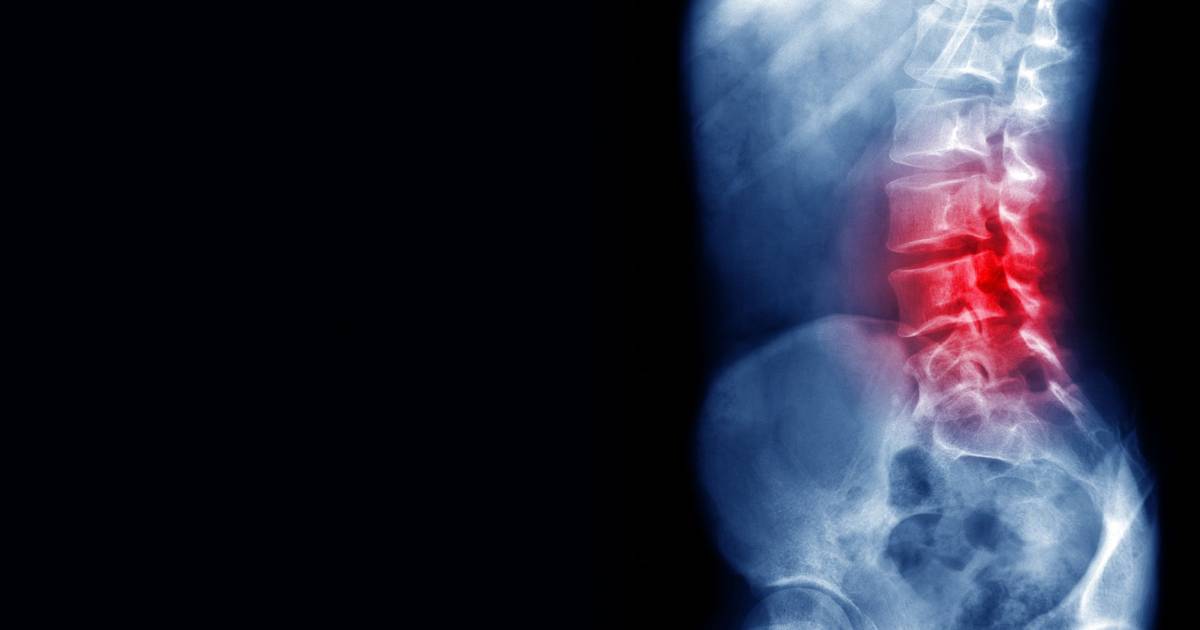 Cirurgia à coluna: terapia psicológica antes da operação reduz impacto da dor e melhora a recuperação